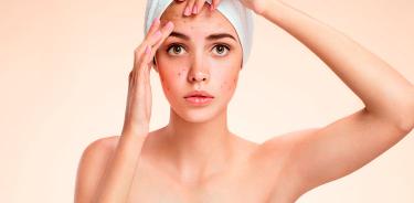 El temible acné afecta más a adolescentes