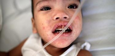 Casos de sarampión se cuadriplicaron en un año, alerta Unicef