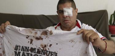 Policías capitalinos lo confunden, lo golpean y pierde su ojo; clama justicia