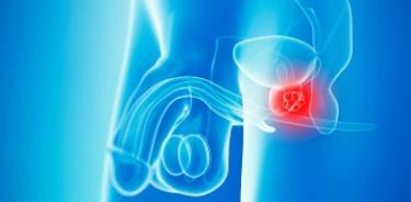 El 70% de casos de cáncer de próstata se diagnostican tarde