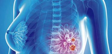 La inmunoterapia mejora resultados en cáncer de mama triple negativo