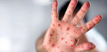 EU registra su segundo mayor brote de sarampión desde el 2000