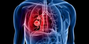 En México, tratar cáncer de pulmón es ocho veces más caro que el de mama