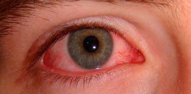Conjuntivitis, infección ocular frecuente sobre todo en niños