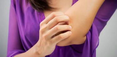 Bajas temperaturas afectan la piel y pueden agravar enfermedades como psoriasis o dermatitis atópica