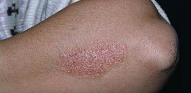 Psoriasis, la enfermedad de la piel que padecen muchos mexicanos