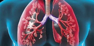 Hipertensión Arterial Pulmonar, enfermedad huérfana, afecta a 3 mil mexicanos