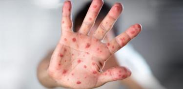 El número de casos de sarampión globales se ha triplicado, advierte OMS