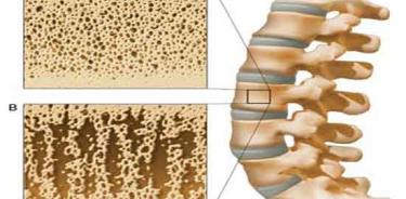 Desacelera los síntomas de la osteoporosis