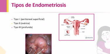 La endometriosis, es una enfermedad que afecta a un importante número de mujeres, no es prevenible, y por sus síntomas se relaciona con el periodo menstrual, por lo que se diagnostica hasta después de 7 años promedio