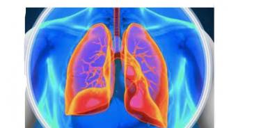 La hipertensión pulmonar, es una especie de presión arterial alta, que afecta las arterias de los pulmones, afección que empeora con el tiempo sin el tratamiento adecuado