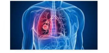 El Instituto Nacional de Cancerología (INCan), cuenta con un programa de detección temprana para tratar tempranamente a pacientes con cáncer de pulmón