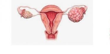Cáncer de ovario, diagnosticado a tiempo brinda altas probabilidades de vencer este padecimiento
