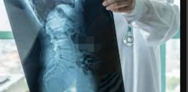 La Atrofia Muscular Espinal (AME), enfermedad de baja prevalencia, que requiere diagnóstico temprano para brindar a estos pacientes una mejor calidad de vida y evitar muerte prematura