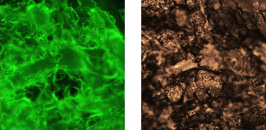Los hidrogeles se tiñeron con un tinte fluorescente que se une a las estructuras amiloides y la imagen de campo claro correspondiente.