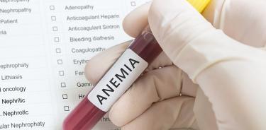 Anemia en adultos, puede ser el primer síntoma de Síndrome Mielodisplásico