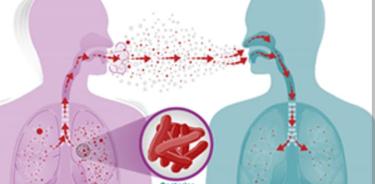 La tuberculosis, se puede contagiar de persona a persona, por contacto con gotículas microscópicas de una persona enferma