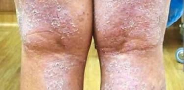 Dermatitis atópica, enfermedad genética que causa resequedad, picazón, descamación de la piel, no es contagiosa, y con un adecuado tratamiento el paciente vive bien