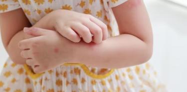 La dermatitis atópica en la infancia si no es controlada adecuadamente, puede ocasionar muchos problemas en las y los menores que la padecen, ya que este padecimiento es incurable