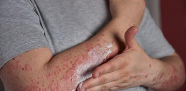 Psoriasis, enfermedad multifactorial de origen genético, incurable, no contagiosa, y con el tratamiento adecuado, el paciente lleva una buena calidad de vida