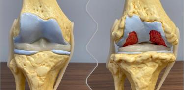 Desgaste articular de rodilla, padecimiento más frecuente en adultos mayores de 60 años, que causa discapacidad por los dolores ocasionado por el roce de huesos