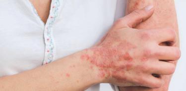 Psoriasis Pustular Generalizada, enfermedad rara de difícil tratamiento, es descrita como la sensación de ardor interno de la piel, que va ocasionando ampollas en todo el cuerpo y un dolor insoportable