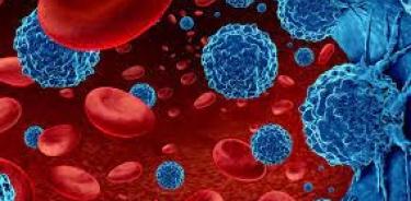 Leucemia Mieloide Aguda, uno de los tipos de cáncer en sangre más agresivos por su rápida evolución