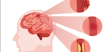 Los accidentes cerebovasculares (ACV)  se caracterizan por la pérdida de suministro de oxígeno al cerebro por rupturas o bloqueos de arterias.