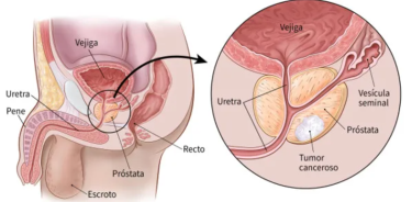 En menos de una década el número de muertes anuales por cáncer de próstata aumentó de 7 mil a 7 mil 500.