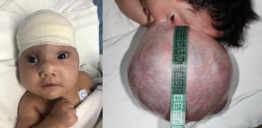 Médicos especialistas de lSSSTE, con sus manos milagrosas, retiran exitosamente  malformación craneal a bebé neonata de dos meses