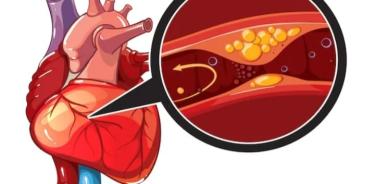 La  enfermedad isquémica coronaria, ocurre cuando las arterias que suministran sangre al músculo del corazón se obstruyen, por lo que hay que acudir a revisión periódica en hombres después de los 35 años y mujeres después de la menopausia