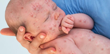 Los bebés sin vacunar son el grupo de población más vulnerable a ser contagiados y sufrir complicaciones por sarampión.