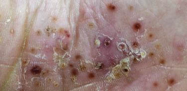 La Psoriasis Pustulosa Generalizada (PPG), es una enfermedad rara de la piel con alto impacto en la salud mental y el bienestar emocional