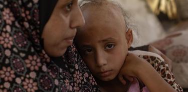 Niña palestina con evidente deterioro físico y de salud tras el bloqueo israelí de Gaza