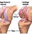 Osteoarthritis is characterized by the gradual destruction of cartilage that prevents direct contact between bones and their wear due to friction.