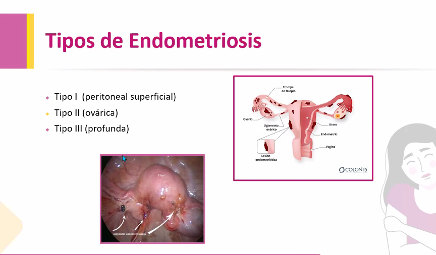 Endometriosis Enfermedad Patológica Que Afecta A La Mayoría De Las Mujeres 5306